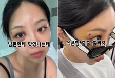 "유현철이 때렸냐"...결혼 앞두고 '멍든 눈' 김슬기 입 열었다