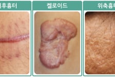 "여드름인 줄 알았는데" 가슴·턱에 '팥알'처럼 볼록…흉터 정체는?