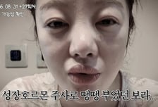 황보라, 시험관 시술 중 퉁퉁 부은 얼굴…"언제까지 반복될지"