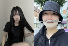 "한국서 수술 받고 입·턱 마비 상태"…日인플루언서 부작용 호소