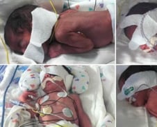 일란성 쌍둥이 두 쌍 한꺼번에 출산한 미 여성 '화제'