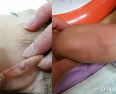 [단독]어린이집 2살 아기 학대 논란, 두손 놓은 경찰 "증거없어서…"