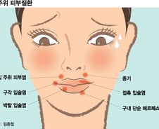 "마스크 벗었더니 입 주변 난리"…여드름이 아니었네