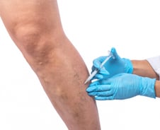 울퉁불퉁 혈관 튀어나오면 다 정맥류? 사실은…