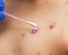 아이 온몸에 물집이…마스크 내리니 수두·볼거리 20%대 급증