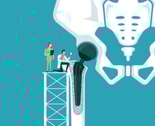 고관절 인공관절 수술, 젊을 때 해도 10년 이상 '거뜬' 세계 첫 보고