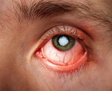 또 눈곱이 덕지덕지…휴가철 불청객 찾아왔다