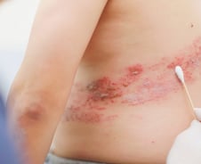 땀이 줄줄, 에어컨 '빵빵' 틀었다가…대상포진 '날벼락'