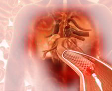 심장혈관 또 막힐라…추석연휴 부모님 '콜레스테롤 수치' 확인하세요