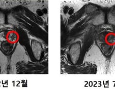 한달만에 암 사라져, 주변 장기 피해 '0'…3000억 들인 '꿈의 치료기' 성공