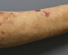 추석에 만난 할머니, 팔이 멍투성이인데 "안 아파"…'이것' 의심해야