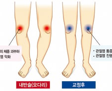 관절염 고생하는 우리 엄마 '오다리'라면…"쫙 피는 수술해야"
