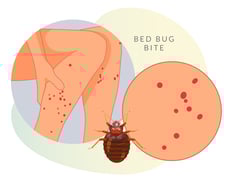 "너무 가려워" 벅벅…'빈대' 물린 곳에 물파스, 효과 있을까? [한 장으로 보는 건강]