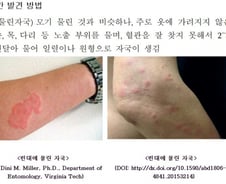 모기처럼 군데군데 원형 자국이…'빈대' 물렸을 때 대응법