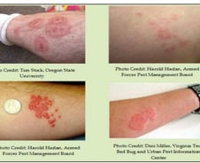 빈대 물리고 "숨 안 쉬어져요"…아나필락시스도 부른다