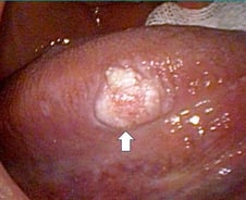 남자만의 병 아니었다…술·담배 즐기던 여성에 급증한 '이 암'