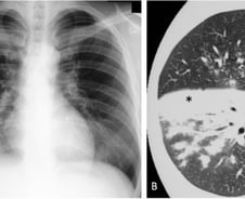 中 휩쓴 이 '폐렴', 독감과 같이 걸린다면…의사 "비극 생길 수도"
