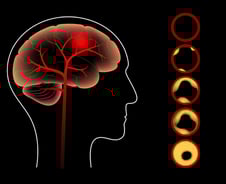 당뇨병·혈관질환 없는 한국인, 넘지 말아야 할 'LDL 마지노선' 나왔다