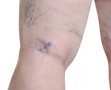 롱부츠 신고 후회…"다리에 지렁이가 꿈틀" 혈관 찾아오는 '이 질환'