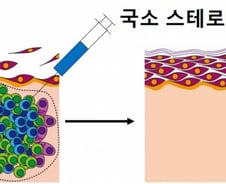 희귀질환 '천포창'의 만성 물집, 국소 스테로이드 주사도 효과적