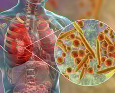 "항생제 안들어" 의료진 다급한 경고…'중국발 폐렴' 무서운 진화