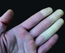 손 꽁꽁 얼었는데 "겨울엔 다 이래"…'하얀 손가락' 방치했다간 절단 위기