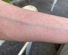 BTS 뷔도 "알레르기 때문에 가렵다"‥일상 방해 '빨간 닭살' 뭐길래