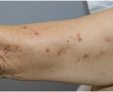 "가려워" 긁다 못해 후벼 판다…손댈수록 악화하는 '이 질환' 뭐길래