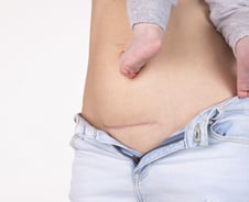 "산통 다 겪고 응급 제왕절개 최악"…20대 절반은 자연분만 안했다