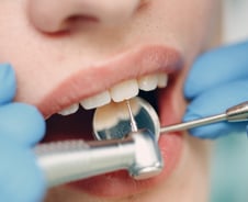 "치아 무 뽑듯 안 뽑게"… 복지부, 치과 추가 급여화·수가 인상 검토