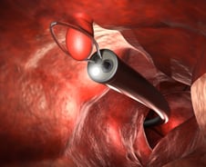 조기 대장암, 배 열지 않고 내시경으로 '싹둑'…전이 위험도 따져 환자 추린다