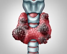 "걸리면 3개월 내 사망"…악질로 불린 '이 암' 새 치료법 찾았다
