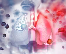 2년도 못 사는 '돌연변이 폐암' 차세대 항암제로 무진행생존기간 2배↑