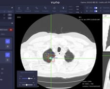 뷰노, '흉부 CT' 인공지능 솔루션 日 보험급여 대상 인정