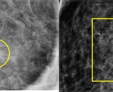가슴 멍울 없었는데 '하얀 가루' 찍혔다?…유방암은 이런 모습