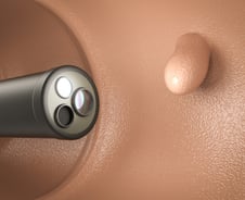 용종 10개 중 9개는 '대장암 씨앗'…정확한 내시경, 나 하기 나름?