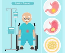 나이 많아서 '위암 수술' 포기?…생존율 영향 미치는 4가지