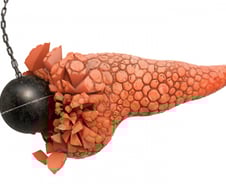 갑자기 생긴 당뇨병 '이 암' 때문?…'기름 낀 대변' 그냥 넘기면 안 돼