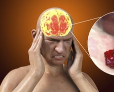 "한번도 경험해보지 못한 두통"…환자 68% 급증한 이 질병