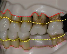 "양치 귀찮아" 자꾸 건너뛰다간…입 냄새 '풀풀' 잇몸뼈 녹아내린다