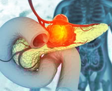 5년 생존율 겨우 15.9%…"초음파 괜찮대" 방심하다 '이 암' 놓친다