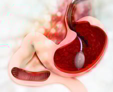 "양성입니다" 코로나 때 기억에 철렁…위내시경 후 놀라지 마세요