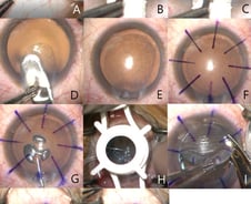 "각막 터질 위험 없어" 망막반사 이용한 새로운 각막이식술 나왔다