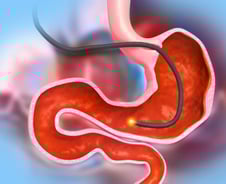 "소화 안되고 속쓰려" 위 문제만이 아니다?…내시경 보니 '이곳' 염증