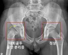 외상없었는데 허벅지뼈 분리? 호르몬 3개 부족하면 발병률 744배↑