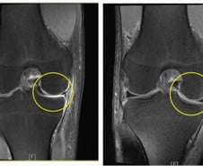 괜찮아지겠지?…무릎서 "사각사각" 연골의 '비명'