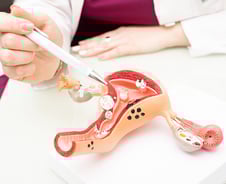 암 위험 큰 '자궁내막 증식증' 저용량 호르몬 치료도 효과 커