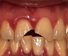 "빠진 치아, 뿌리 말고 머리 잡으세요" 상황별 치아 응급상황 대처법