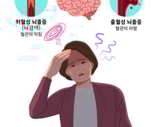 갑자기 발음 어눌해지고 걸음 휘청…뇌혈관 골든타임 '270분'