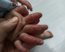 "아기 온몸이 피투성이"…'연 800만원' 영유아 아토피약, 80만원대로